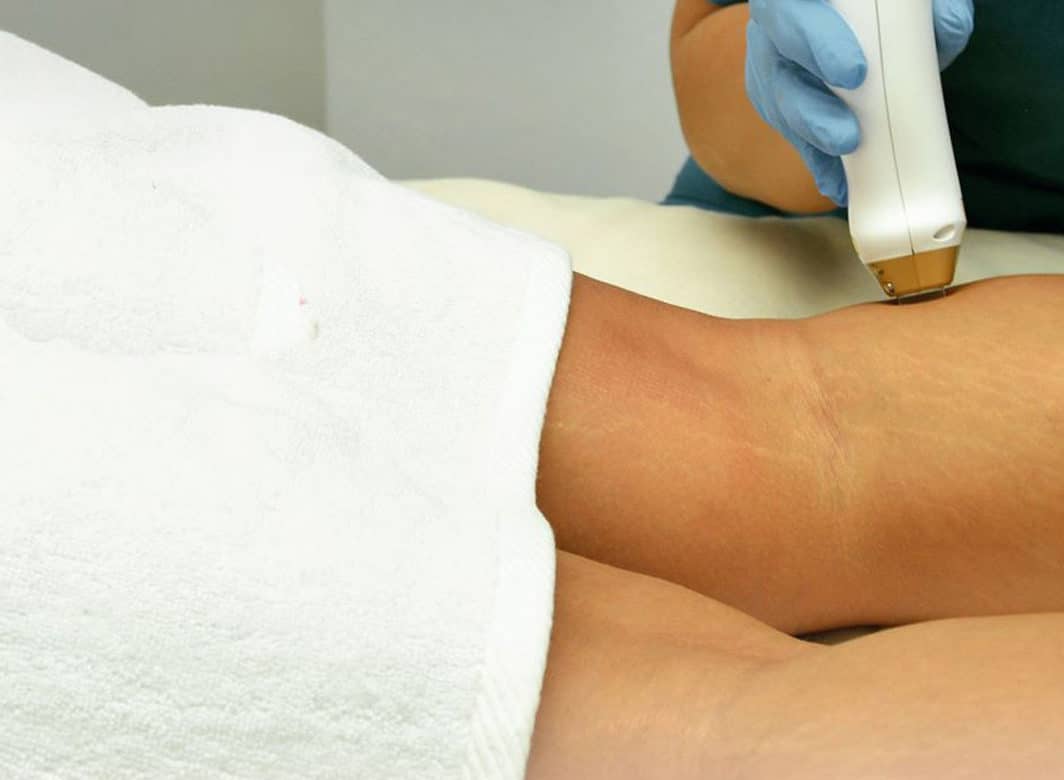 Traitement électrochirurgical Paris